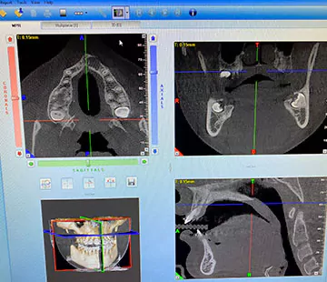 MPR Screen of Special CBCT Screen